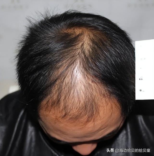 子最好？育发液什么牌子最有效果？AG真人旗舰厅日本生发液哪个牌(图4)